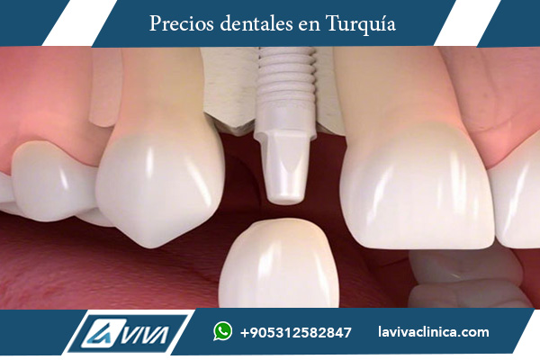 implante de zirconio duración, cuánto dura un implante dental, años de vida de implante de zirconio, implantes dentales de zirconio opiniones, zirconio o titanio ventajas , implante de zirconio, duración implantes dentales, estética dental zirconio, ventajas del zirconio, implantes dentales modernos, cuidados de implantes , ¿Es duradero un implante de zirconio?, ¿Cuánto cuesta un implante de zirconio?, ¿Cuáles son los cuidados de un implante dental?, diferencias entre zirconio y titanio