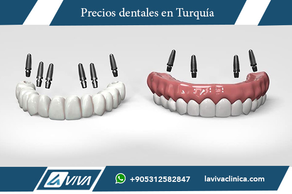 puente de implantes de zirconio, costo de puente de zirconio arco completo, precio implantes de zirconio Turquía, puente dental zirconio ventajas, tratamientos dentales Turquía, clínica dental en Turquía, puente zirconio arco completo costo, experiencia paciente implantes Turquía, materiales dentales zirconio, puente dental fijo zirconio , implantes de zirconio, puente dental, costo de tratamientos dentales, odontología en Turquía, puente de zirconio ventajas, tratamiento dental completo, clínicas dentales Turquía, turismo dental Turquía, zirconio dental , ¿cuánto cuesta un puente dental?, ¿es mejor el zirconio que otros materiales?, ¿cuánto cuesta un arco completo en Turquía?, ¿qué incluye el costo de un puente dental?, ¿es Turquía una buena opción para tratamientos dentales?, ¿qué ventajas tiene un puente de zirconio?, ¿cuál es la diferencia entre zirconio y cerámica?, ¿qué clínicas en Turquía ofrecen implantes de zirconio?, ¿cómo es el proceso de colocación de un puente dental?