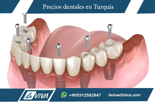 coronas dentales de porcelana pura, coronas de zirconio en Turquía, materiales para coronas dentales, coronas metal-porcelana, tratamiento dental en Turquía, disilicato de litio en coronas dentales, precio de coronas dentales en Turquía, mejores opciones para coronas dentales, comparación de materiales dentales, turismo dental en Estambul , coronas dentales, materiales dentales, odontología estética, tratamientos dentales, turismo dental, cuidado dental, estética dental, zirconio, porcelana dental, clínica dental en Estambul , ¿qué material es mejor para coronas dentales?, ¿qué opciones de coronas dentales existen?, ¿cuál es el precio de las coronas dentales?, ¿qué es una corona dental?, ¿cómo elegir una corona dental?, ¿qué material dental dura más?, ¿qué son las coronas de porcelana?, ¿dónde realizarme coronas dentales?, ¿cuál es el mejor país para turismo dental?