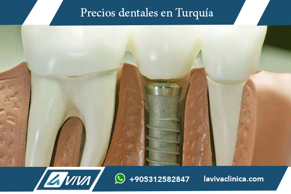 Implantes Dentales España , implantes dentales, precios implantes Turquía, odontología Turquía, tratamientos dentales económicos, clínicas dentales Turquía, turismo dental, beneficios implantes dentales, comparación precios dentales