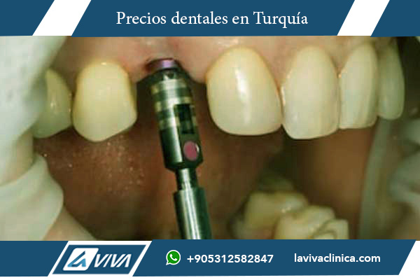 Implantes Dentales en Canadá , implantes dentales Turquía, costos de implantes dentales, calidad de implantes dentales Turquía, dentistas en Turquía, tratamientos dentales económicos Turquía, turismo médico Turquía, clínicas dentales Turquía, implantes dentales en Estambul