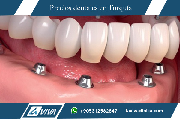 Implantes Dentales en Estados Unidos , implantes dentales Turquía, costos implantes dentales, turismo dental, salud dental en Turquía, ahorro dental internacional, tratamientos dentales Turquía, odontología en Turquía, dentistas certificados Turquía