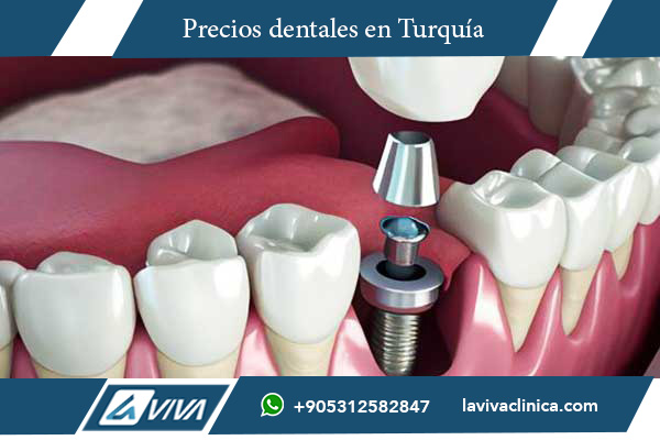 Implantes Dentales en Hungría , implantes dentales, precios implantes dentales, turismo dental, Hungría vs Turquía, clínicas dentales Turquía, calidad dental, ahorro dental, tratamientos dentales