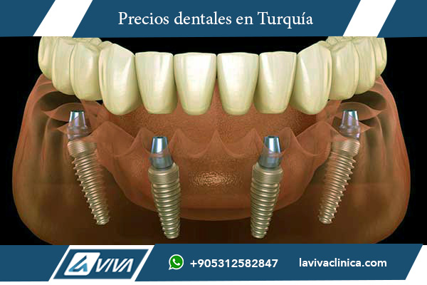 Implantes Dentales en Italia , implantes dentales Italia Turquía, costo implantes dentales, turismo dental, ahorro en tratamientos dentales, calidad dental Turquía