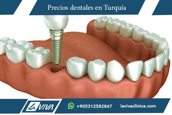 Implantes Dentales en Suecia , implantes dentales, precios implantes Suecia Turquía, turismo dental, ahorro dental, clínicas dentales Turquía, calidad implantes, odontología avanzada Turquía, cirugía dental Turquía