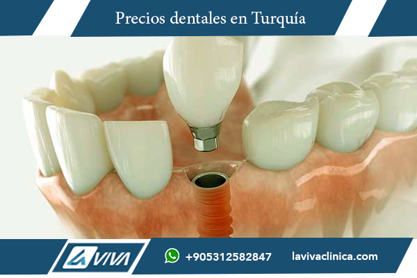 implantes dentales en Francia , implantes dentales en Turquía, comparación costos dentales Francia Turquía, beneficios tratamientos dentales Turquía, ahorro dental internacional, turismo dental