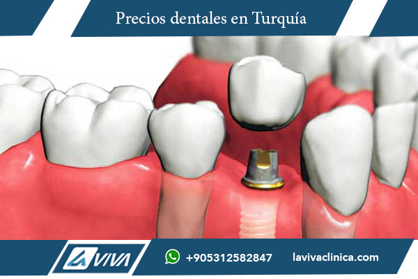 implantes dentales en Polonia , precios implantes dentales, implantes dentales Turquía, turismo dental, calidad dental Turquía, paquetes dentales Turquía, ahorro dental Turquía, clínicas dentales Turquía, comparación dental Polonia Turquía, dentistas expertos Turquía, beneficios implantes Turquía