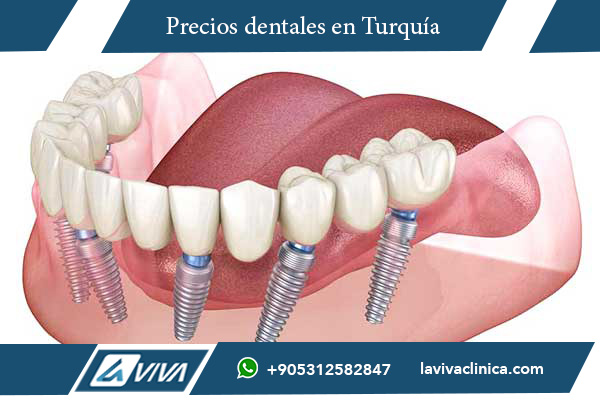 implantes dentales en Portugal , implantes dentales, comparación dental Turquía Portugal, costos dentales Turquía, turismo dental, tratamientos dentales en Turquía, odontología avanzada Turquía, implantes económicos Turquía