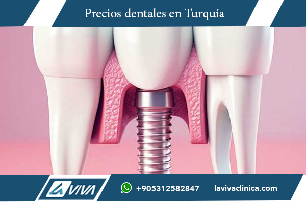 implantes dentales en Rumanía , implantes dentales Turquía, precios implantes dentales, clínicas dentales Turquía, turismo médico Turquía, ahorro implantes dentales, calidad implantes Turquía, tratamientos dentales Turquía