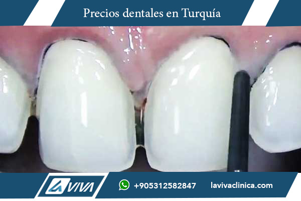 sonrisa de Hollywood en Hungría , sonrisa de Hollywood, costos dentales Turquía, tratamientos dentales Hungría, comparación Turquía Hungría sonrisa de Hollywood, odontología estética Turquía, dentistas Turquía, turismo dental Turquía