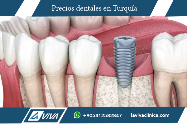 implantes dentales, comparación de precios, Turquía vs Ucrania, turismo dental, odontología estética, ahorro en implantes, mejores clínicas dentales, implantes baratos, implantes de titanio, carillas dentales, tecnología dental avanzada, salud bucal, odontólogos expertos, cirugías dentales, tratamientos dentales económicos, clínicas dentales en Turquía, implantes dentales en Ucrania, beneficios de Turquía para implantes, precios de implantes en Europa, turismo médico