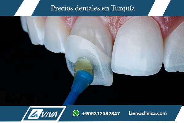 carillas dentales, precios de carillas, comparación de precios, carillas en Francia, carillas en Turquía, turismo dental, ahorro en tratamientos dentales, calidad dental Turquía, sonrisas perfectas, estética dental, dentista en Turquía, carillas de porcelana, carillas de composite, clínica dental Turquía, Dr. Wahid Katkhuda, Laviva Clinic, tratamientos dentales económicos, experiencias de turismo dental, beneficios de carillas dentales, costos de carillas dentales, mejores precios carillas, elegir Turquía para carillas