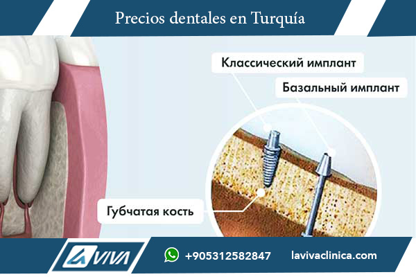 implantes dentales Turquía, implantes dentales India, comparación de precios implantes, turismo dental Turquía, costo implantes dentales, calidad implantes dentales, tecnología dental Turquía, clínicas dentales Turquía, odontología Turquía, mejor país para implantes dentales, salud dental, ahorro en implantes, odontólogos Turquía, dientes perfectos, precios odontología India