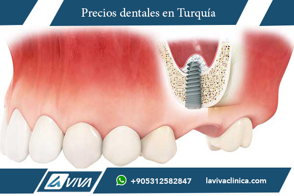 implantes dentales, Turquía, Filipinas, precios de implantes dentales, odontología estética, turismo dental, costo de implantes, clínicas dentales, salud dental, tratamientos dentales, implantes de carga inmediata, All-on-4, All-on-6, comparación de precios, calidad odontológica, dentistas expertos, odontología avanzada, injerto óseo, carillas dentales, coronas dentales, turismo médico, atención dental, implantes económicos, odontología internacional