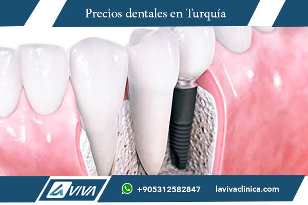 implantes dentales, comparación de precios implantes dentales, implantes dentales Turquía, implantes dentales Brasil, turismo dental, costos implantes dentales, odontología estética, clínicas dentales Turquía, salud dental, implantes dentales baratos, mejores implantes dentales, odontólogos en Turquía, carillas dentales, turismo médico, odontología avanzada