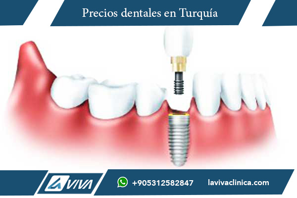 implantes dentales , implantes dentales en Turquía , comparación de precios de implantes dentales , implantes dentales en Colombia , costo de implantes dentales , turismo dental en Turquía , mejores clínicas dentales en Turquía , implantes de carga inmediata , carillas dentales en Turquía , odontología estética , tratamientos dentales en Turquía , clínicas dentales certificadas , precios de implantes en Turquía , experiencia de pacientes en Turquía , salud dental , implantes dentales baratos , calidad dental en Turquía , beneficios del turismo dental , dentistas expertos en Turquía , implantes dentales de alta calidad