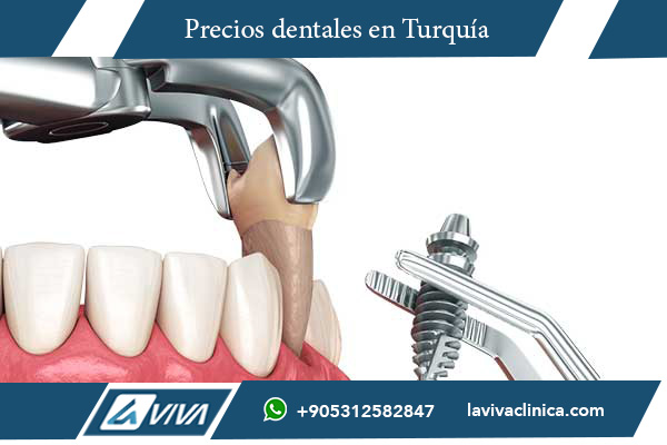 implantes dentales, implantes dentales en Turquía, implantes dentales en Grecia, comparación de precios implantes dentales, implantes dentales baratos, turismo dental en Turquía, mejores clínicas dentales Turquía, precios implantes dentales Grecia, precios implantes dentales Turquía, carillas dentales Turquía, carillas dentales Grecia, salud dental Turquía, costos implantes dentales, implantología dental, dentistas en Turquía, tratamiento dental en el extranjero, odontología estética, turismo de salud