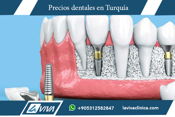 implantes dentales Turquía, precios implantes dentales Turquía, comparación implantes dentales Sudáfrica Turquía, turismo dental Turquía, costo implantes dentales, clínicas dentales Turquía, implantes dentales baratos, mejores clínicas dentales Turquía, implantes dentales calidad Turquía, paquetes dentales Turquía, odontología en Turquía, implantes dentales sin dolor, ventajas implantes dentales Turquía, salud dental Turquía, tratamiento dental en el extranjero