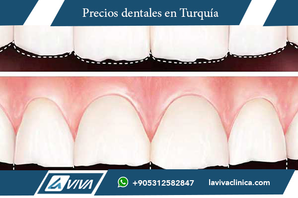 carillas dentales, precios carillas dentales, carillas dentales Turquía, carillas dentales Noruega, comparación precios carillas dentales, carillas dentales baratas, turismo dental Turquía, odontología estética, carillas porcelana, carillas composite, Lumineers, ahorro en carillas dentales, mejor clínica dental Turquía, Laviva Clinic, Dr. Wahid Katkhuda, sonrisa perfecta, tratamiento dental Turquía, calidad dental Turquía, experiencia dental Turquía, turismo y tratamiento dental, dentistas cualificados Turquía, carillas dentales precio Turquía, carillas dentales precio Noruega, clínica dental Turquía, carillas dentales económicas