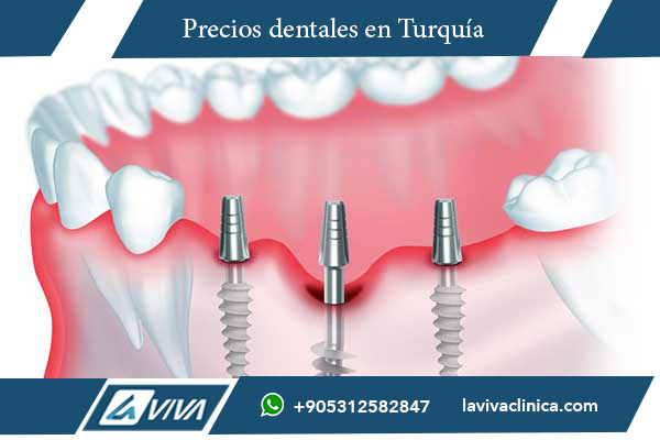 implantes dentales en Turquía, comparación implantes Turquía Suiza, precios implantes dentales Suiza, turismo dental Turquía, costos odontológicos Turquía, clínicas dentales en Estambul, implantes dentales baratos, mejor país para implantes dentales, odontología en Turquía, tratamientos dentales en Turquía, cirugía dental Turquía, implantes dentales de titanio, odontólogos en Turquía, paquetes dentales Turquía, carillas dentales Turquía, estética dental en Turquía, turismo odontológico, salud bucal en Turquía