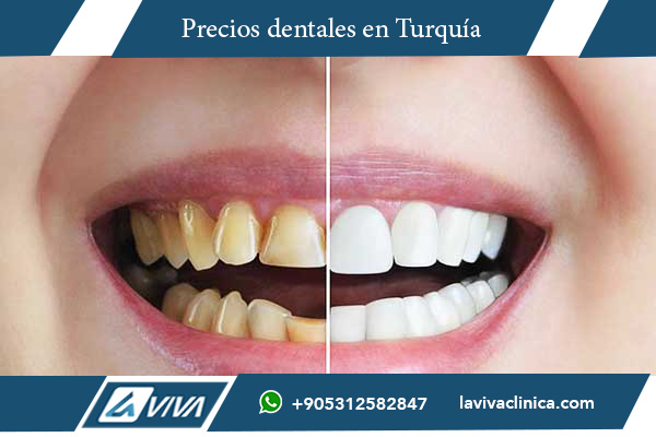 carillas dentales, precios carillas dentales, carillas dentales Australia, carillas dentales Turquía, comparación de precios dentales, turismo dental Turquía, costos dentales Australia, ahorro dental Turquía, mejores clínicas dentales Turquía, Laviva Clinic, Dr. Wahid Katkhuda, tratamientos dentales Turquía, calidad dental Turquía, turismo médico, sonrisa perfecta, carillas de porcelana, carillas de composite, estética dental, tecnología dental avanzada, paquetes dentales Turquía