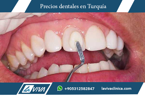 carillas dentales, comparación de precios, Turquía vs Finlandia, odontología estética, turismo dental, costos de carillas, dentistas en Turquía, dentistas en Finlandia, carillas de porcelana, carillas de composite, calidad dental, ahorro en tratamientos dentales, experiencia cultural, Laviva Clinic, Dr. Wahid Katkhuda, sonrisas perfectas, tratamiento dental internacional, carillas asequibles, estética dental Turquía, clínicas dentales Turquía, turismo médico Turquía