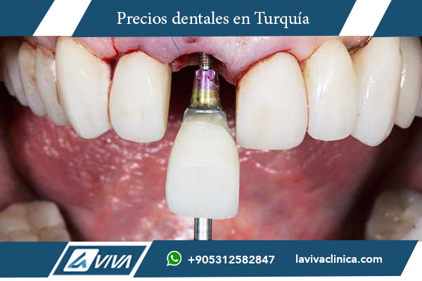 implantes dentales, comparación de precios implantes dentales, implantes dentales Turquía, implantes dentales Finlandia, turismo dental, odontología en Turquía, mejor país para implantes dentales, precios implantes dentales Turquía, clínicas dentales Turquía, carillas dentales Turquía, costos de implantes dentales, salud dental, tratamientos dentales Turquía, turismo médico, odontólogos en Turquía, dentistas certificados, implantes dentales económicos, odontología estética, beneficios de los implantes dentales, implantes dentales baratos, implantes dentales alta calidad