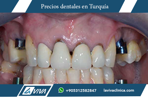 implantes dentales Turquía, implantes dentales Lituania, comparación de precios implantes, turismo dental Turquía, costos implantes dentales, odontología Turquía, odontología Lituania, mejor país para implantes dentales, clínicas dentales Turquía, dentistas en Turquía, tratamientos dentales Turquía, All-on-4 Turquía, All-on-6 Turquía, carillas dentales Turquía, prótesis dentales Turquía, salud dental internacional, mejores precios implantes dentales