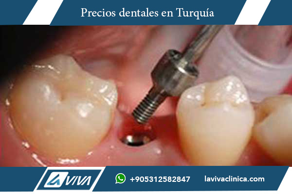 implantes dentales, precios de implantes dentales, Turquía vs Letonia, turismo dental en Turquía, clínica dental en Turquía, implantes de carga inmediata, All-on-4, All-on-6, odontología en Turquía, comparación de precios dentales, dentistas en Turquía, tratamiento dental en el extranjero, mejores clínicas dentales, carillas dentales, odontología estética, costos de implantes, salud dental, injerto óseo, turismo médico, ahorro en tratamientos dentales