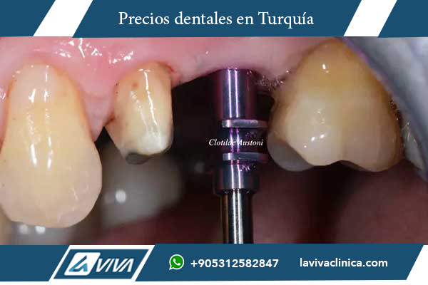 implantes dentales en Turquía, comparación de precios de implantes dentales, implantes dentales en Estonia, turismo dental en Turquía, odontología en Turquía, precios de implantes dentales, mejores países para implantes dentales, calidad dental en Turquía, clínicas dentales en Turquía, ahorro en implantes dentales, All-on-4 Turquía, All-on-6 Turquía, carillas dentales Turquía, salud bucal, dentistas en Turquía