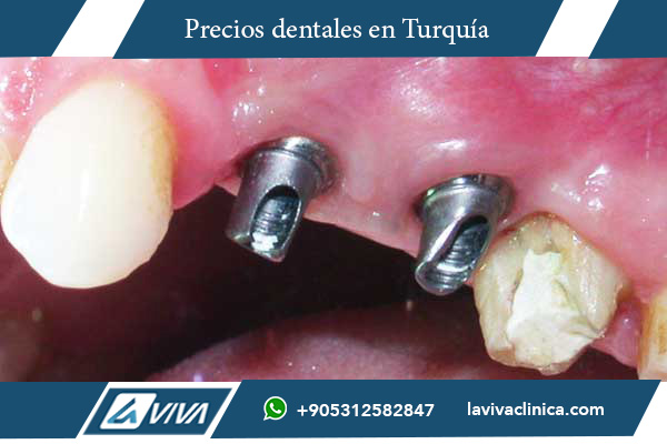 implantes dentales, Turquía, Irlanda, precios implantes dentales, comparación implantes dentales, turismo dental, ahorro implantes, odontología Turquía, implantes dentales baratos, clínicas dentales Turquía, calidad dental, salud bucal, odontología estética, cirugía oral, tratamiento dental, implantología avanzada, turismo médico, precios odontológicos, dentistas Turquía, implantes asequibles