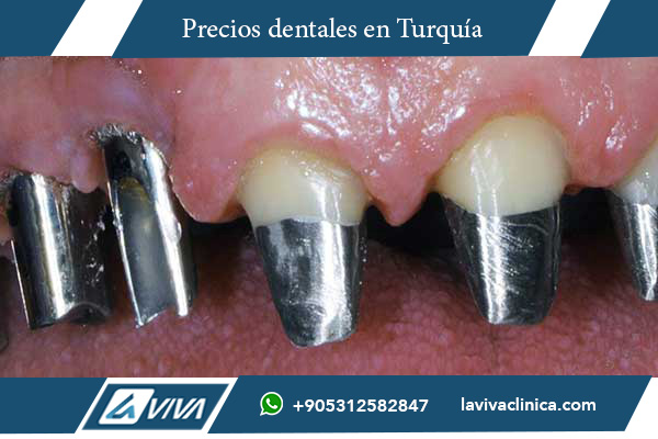 implantes dentales, precios implantes dentales, implantes dentales Turquía, implantes dentales Bosnia y Herzegovina, comparación implantes dentales, odontología Turquía, turismo dental, implantes dentales baratos, carillas dentales Turquía, mejor país para implantes dentales, costos implantes dentales, salud dental, clínicas dentales Turquía, All-on-4, All-on-6, odontólogos especialistas, estética dental, tecnología dental avanzada, paquetes dentales Turquía