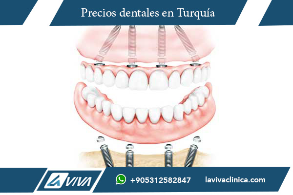 implantes dentales, precios de implantes dentales, Turquía vs Albania, turismo dental Turquía, implantes dentales en Turquía, odontología estética, salud bucal, clínicas dentales en Turquía, calidad odontológica, All-on-4, All-on-6, implantología avanzada, comparación de costos dentales, dentistas en Turquía, implantes dentales baratos, corona dental zirconio, odontología Turquía, mejor destino dental, turismo médico