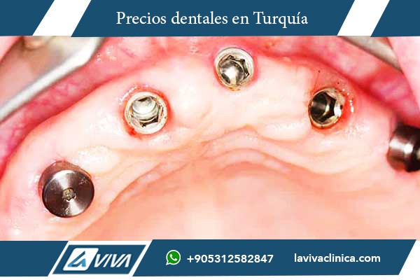 implantes dentales, Turquía, Macedonia del Norte, precios implantes dentales, comparación de precios, turismo dental, calidad dental Turquía, clínicas dentales, odontología en Turquía, implantes asequibles, atención dental, costos odontológicos, paquetes dentales Turquía, carillas dentales, turismo médico, salud dental