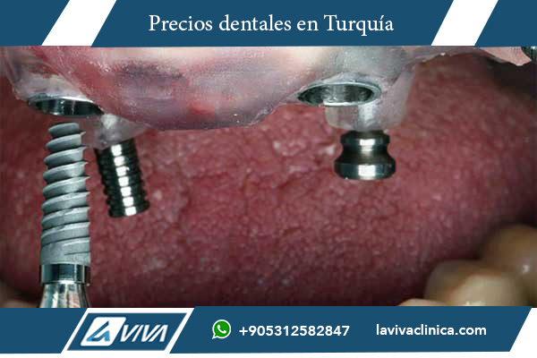 implantes dentales, precios de implantes dentales, implantes dentales Turquía, implantes dentales Eslovenia, comparación de implantes dentales, turismo dental Turquía, clínica dental Turquía, implantes baratos Turquía, implantes dentales costos, salud dental, odontología en Turquía, implantes dentales alta calidad, turismo médico Turquía, odontología estética, implantes dentales precio Eslovenia, tratamientos dentales internacionales, clínicas dentales certificadas, odontología avanzada, implantes dentales con garantía, ahorro en tratamientos dentales