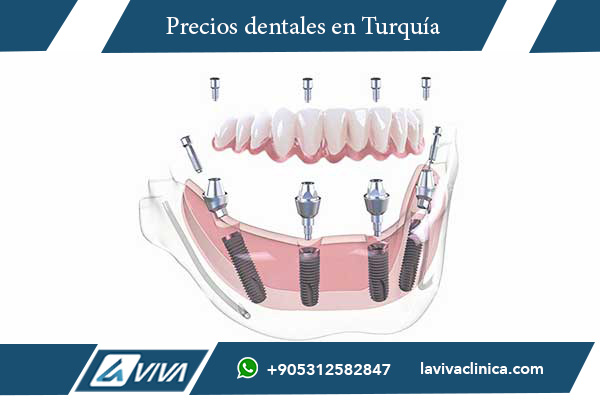 turismo dental, implantes dentales Turquía, comparación dental Hungría Turquía, carillas dentales Turquía, costos dentales Turquía, odontología estética, clínicas dentales Turquía, mejor país para tratamiento dental, precios implantes Turquía, blanqueamiento dental barato, tratamientos dentales asequibles, odontología de calidad, turismo médico Turquía, paquetes dentales todo incluido, dentistas certificados Turquía, comparación precios dentales, ahorro en tratamientos dentales