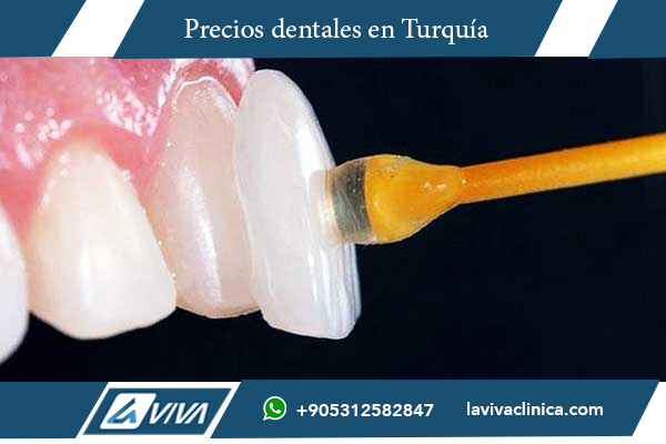 carillas dentales, precios carillas dentales, carillas dentales Hungría, carillas dentales Turquía, comparación precios carillas, carillas porcelana, carillas composite, turismo dental Turquía, mejores dentistas Turquía, Laviva Clinic, Dr. Wahid Katkhuda, estética dental, tratamientos dentales, odontología estética, costos carillas dentales, carillas económicas Turquía, turismo dental, sonrisa perfecta, calidad dental Turquía, experiencia dental Turquía