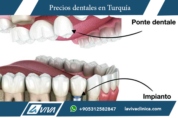 turismo dental, implantes dentales Turquía, carillas dentales Turquía, comparación precios dentales Polonia Turquía, clínicas dentales en Turquía, ortodoncia Turquía, blanqueamiento dental Turquía, tratamientos dentales baratos, mejores dentistas en Turquía, salud bucal, costos dentales Turquía, odontología cosmética, sonrisas perfectas, dental travel, precio implantes dentales, carillas de porcelana, mejor país para tratamientos dentales