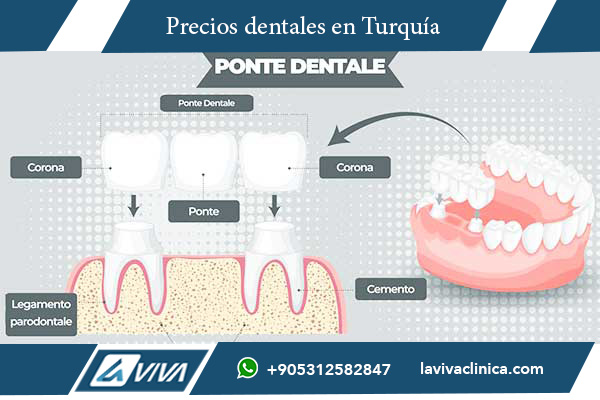 tratamiento dental Turquía, comparación dental Turquía Ucrania, precios implantes dentales Turquía, carillas dentales Turquía, odontología estética Turquía, turismo dental Turquía, dentistas en Turquía, costos dentales Ucrania vs Turquía, salud bucal en Turquía, ahorro en tratamientos dentales, clínicas dentales en Turquía, implantes dentales económicos, odontología moderna Turquía, ortodoncia Turquía, blanqueamiento dental Turquía