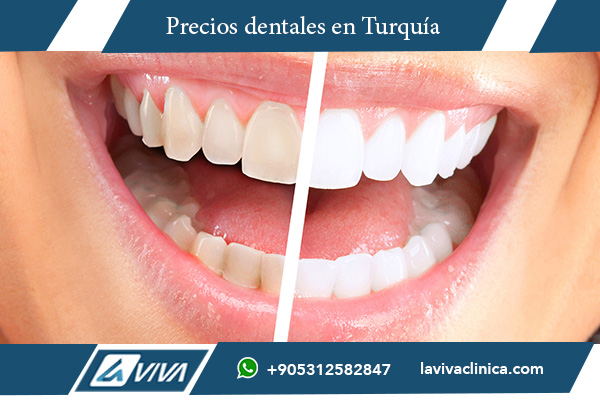 carillas dentales, precios de carillas dentales, carillas dentales Turquía, carillas dentales Argelia, comparación de precios, carillas de porcelana, carillas de composite, turismo dental, turismo médico Turquía, estética dental, ahorro en carillas dentales, clínica dental Turquía, Laviva Clinic, Dr. Wahid Katkhuda, calidad dental Turquía, sonrisa perfecta, tratamiento dental, odontología estética, Turquía vs Argelia, elegir Turquía, beneficios carillas dentales, costo carillas dentales, experiencia dental Turquía