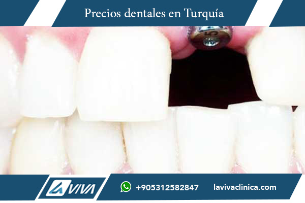 tratamiento dental en Turquía, implantes dentales Turquía, comparación precios dentales, turismo dental Turquía, carillas dentales Turquía, clínicas dentales Turquía, odontología en Turquía, precios implantes dentales, turismo odontológico Turquía, dentistas en Turquía, mejor país para tratamiento dental, salud dental en Turquía, costos dentales Turquía, corona dental Turquía, blanqueamiento dental Turquía, comparación dental República Checa y Turquía, odontología moderna Turquía, clínicas dentales acreditadas Turquía, turismo médico dental, paquetes odontológicos Turquía