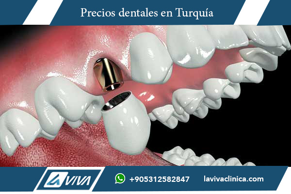 implantes dentales, comparación de precios, Turquía vs Croacia, turismo dental, implantes baratos, calidad dental Turquía, clínicas dentales Turquía, odontología estética, paquetes dentales Turquía, ahorro en implantes, dentistas expertos, salud dental internacional, tratamientos dentales, costos de implantes, mejor destino dental, atención odontológica, tecnología dental avanzada, turismo médico, testimonios de pacientes, ventajas de Turquía