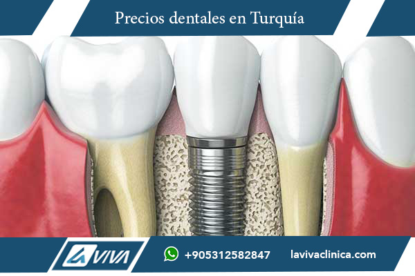 tratamiento dental en turquía, comparación de precios dentales, implantes dentales baratos, carillas dentales turquía, odontología estética, turismo dental en turquía, ahorro en tratamientos dentales, clínicas dentales turquía, salud dental internacional, dentistas en turquía, blanqueamiento dental, ortodoncia turquía, tecnología odontológica, tratamientos dentales seguros, implantes dentales españa vs turquía