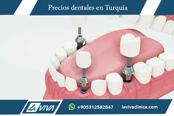 tratamiento dental Turquía, implantes dentales Turquía, carillas dentales Turquía, blanqueamiento dental Turquía, coronas dentales Turquía, ortodoncia Turquía, turismo dental Turquía, clínicas dentales Turquía, odontólogos en Turquía, comparación precios dentales Portugal Turquía, mejores clínicas dentales Turquía, precios implantes dentales Turquía, paquetes dentales Turquía, salud dental en Turquía, turismo odontológico, ahorro en tratamientos dentales, clínicas certificadas en Turquía, estética dental Turquía, tratamientos dentales baratos, dentistas en Turquía