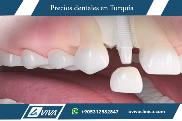 tratamientos dentales , implantes dentales , carillas dentales , odontología en Turquía , costos odontológicos , comparación Italia Turquía , turismo dental , clínicas dentales , salud dental , ahorro en tratamientos dentales , tecnología avanzada , dentistas certificados , calidad odontológica , turismo médico , beneficios dentales , tratamientos odontológicos económicos , implantes en Turquía , carillas estéticas , turismo odontológico , salud bucal , clínicas dentales Turquía , odontología internacional , tratamientos dentales accesibles , cirugía dental Turquía , odontología estética , turismo salud dental , procedimientos odontológicos Turquía , ortodoncia Turquía , blanqueamiento dental Turquía