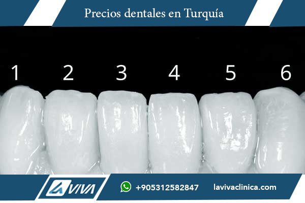 carillas dentales, comparación de precios, Turquía, Bulgaria, turismo dental, carillas de porcelana, carillas de composite, ahorro en tratamientos dentales, Laviva Clinic, Dr. Wahid Katkhuda, calidad dental Turquía, precios dentales Turquía, estética dental, sonrisa perfecta, tratamientos dentales económicos, turismo médico, dentistas en Turquía, carillas dentales Turquía, carillas dentales Bulgaria, costo de carillas, experiencia dental, mejores dentistas, carillas estéticas, carillas de dientes, transformación de sonrisa