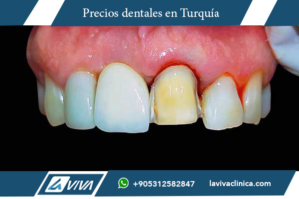 carillas dentales, precios carillas dentales, carillas dentales Turquía, carillas dentales Estados Unidos, comparación precios carillas, carillas porcelana, carillas composite, dentista Turquía, turismo dental Turquía, ahorro en carillas, tratamiento dental internacional, estética dental, sonrisa perfecta, Laviva Clinic, Dr. Wahid Katkhuda, clínicas dentales Turquía, costo carillas dentales, carillas dentales económicas, carillas dentales calidad, viaje dental Turquía, experiencia dental Turquía