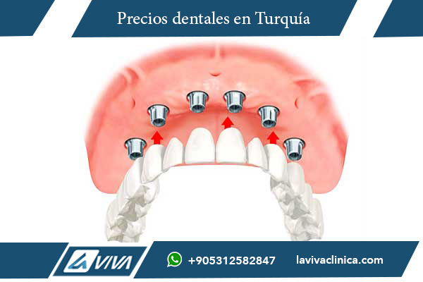 implantes dentales, precios implantes dentales, implantes dentales en Turquía, implantes dentales en México, comparación implantes dentales, turismo dental, odontología en Turquía, costos de implantes dentales, calidad de implantes dentales, carillas dentales, tratamientos dentales en Turquía, clínicas dentales en Turquía, cirugía dental, odontología estética, salud dental internacional