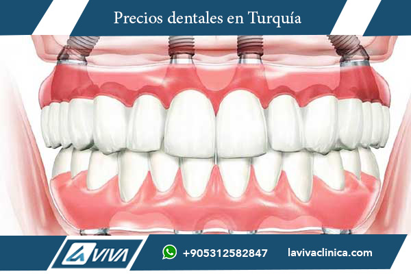 implantes dentales, precios de implantes dentales, implantes dentales en Turquía, implantes dentales en Costa Rica, comparación de precios de implantes, turismo dental, odontología en Turquía, implantes asequibles, calidad dental Turquía, tratamientos dentales, carillas dentales, odontología estética, mejores implantes dentales, clínica dental Turquía, odontólogos certificados, ahorro en implantes, paquetes dentales Turquía, costo de implantes dentales, dentistas en Turquía, odontología internacional, cirugía dental