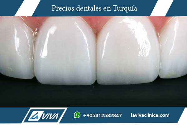 carillas dentales, comparación de precios, Alemania, Turquía, turismo dental, carillas de porcelana, carillas de resina compuesta, Lumineers, diseño de sonrisa, costos dentales, tratamientos dentales, calidad dental Turquía, Laviva Clinic, Dr. Wahid Katkhuda, ahorro en carillas, turismo médico, sonrisa perfecta, estética dental, precio carillas Alemania, precio carillas Turquía, carillas baratas, odontología estética, viaje dental, mejores dentistas Turquía, clínicas dentales Turquía, carillas dentales Turquía, carillas dentales Alemania